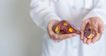 Steatoza hepatică. Cum să recunoașteţi și să trataţi boala ficatului gras