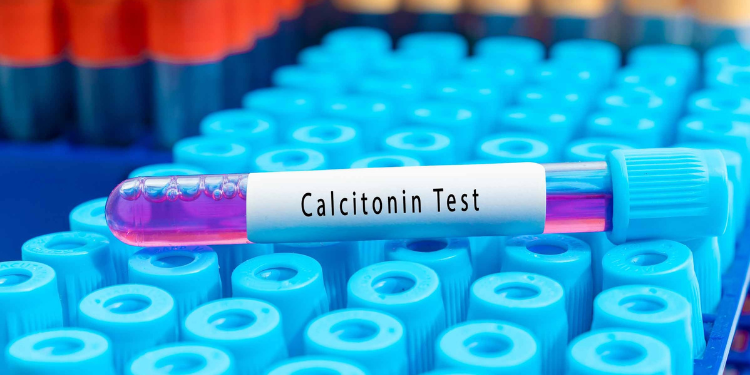 Ce este calcitonina? Informații despre valori normale. Interpretare rezultate