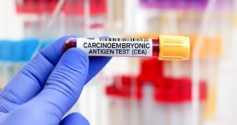 Antigen carcinoembrionic (CEA). Ce este. Cum este utilizat în diagnosticul cancerului