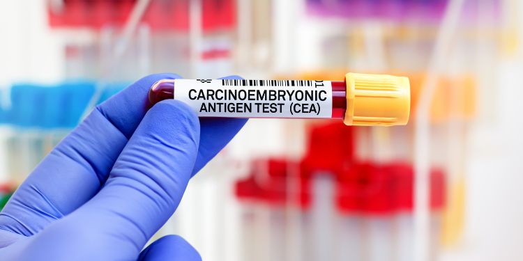 Antigen carcinoembrionic (CEA). Ce este. Cum este utilizat în diagnosticul cancerului