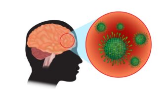 Ce este meningita bacteriană. Cauze, tratament și prevenție