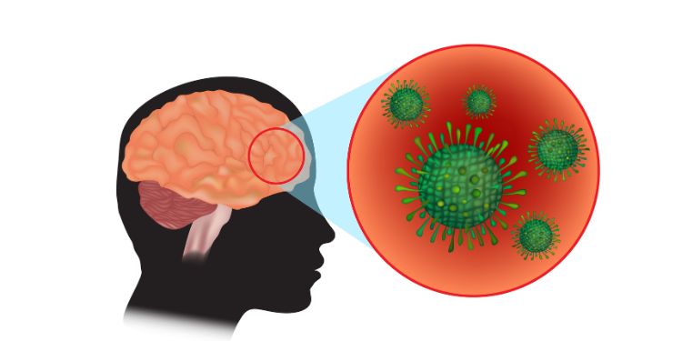 Ce este meningita bacteriană. Cauze, tratament și prevenție