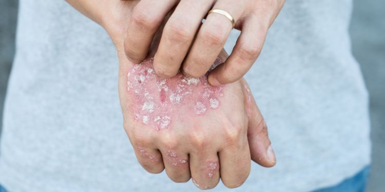 simptome psoriazis