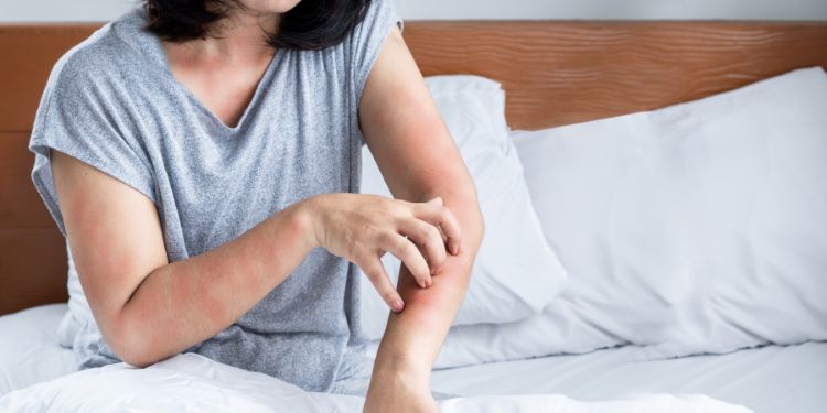 Alergia la praf, spimtome cutanate, eczema, siptome alergie la praf si acarieni, 