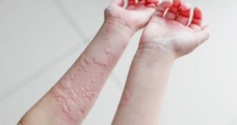 De ce apare urticaria la copii? Cauze, diagnostic și tratament pentru urticarie