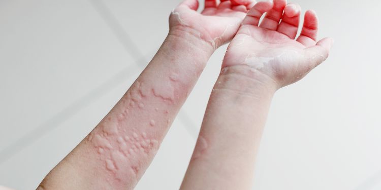 De ce apare urticaria la copii? Cauze, diagnostic și tratament pentru urticarie